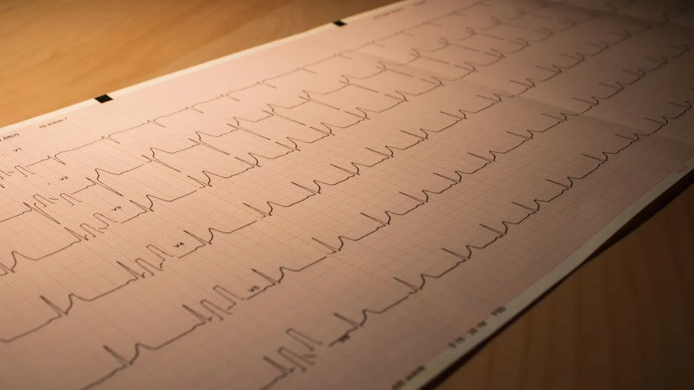 Tira de papel de electrocardiograma con los trazos del ritmo del corazón, extendida sobre una mesa de madera: imagen para la guía de la arritmia